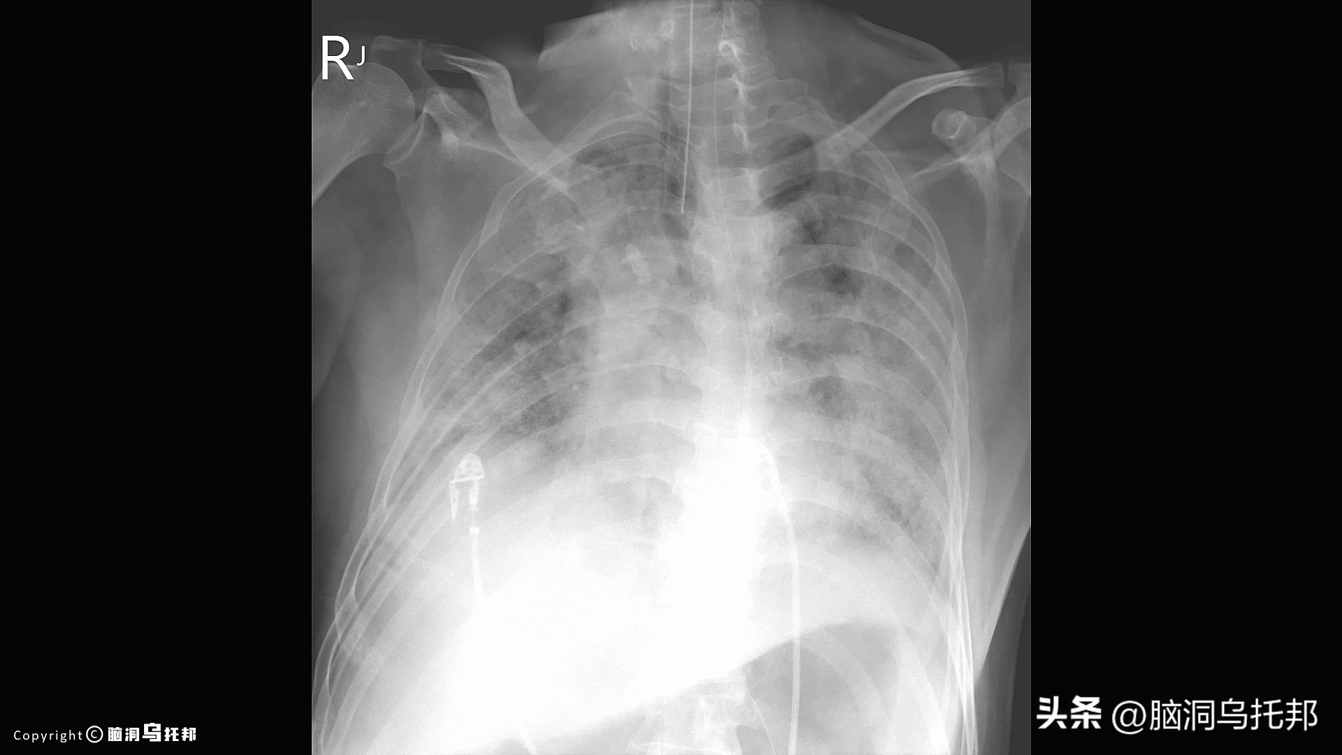 无症状感染是因为体质差吗,为什么有的人感染症状轻