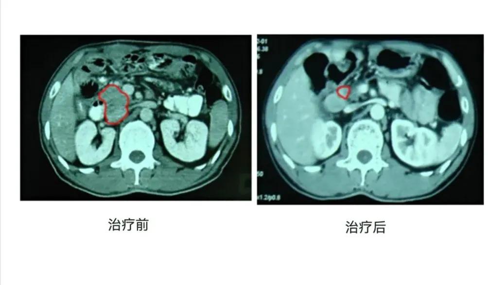 胰腺癌病人20年生存奇迹？让我们“一起寻找姜福生”
