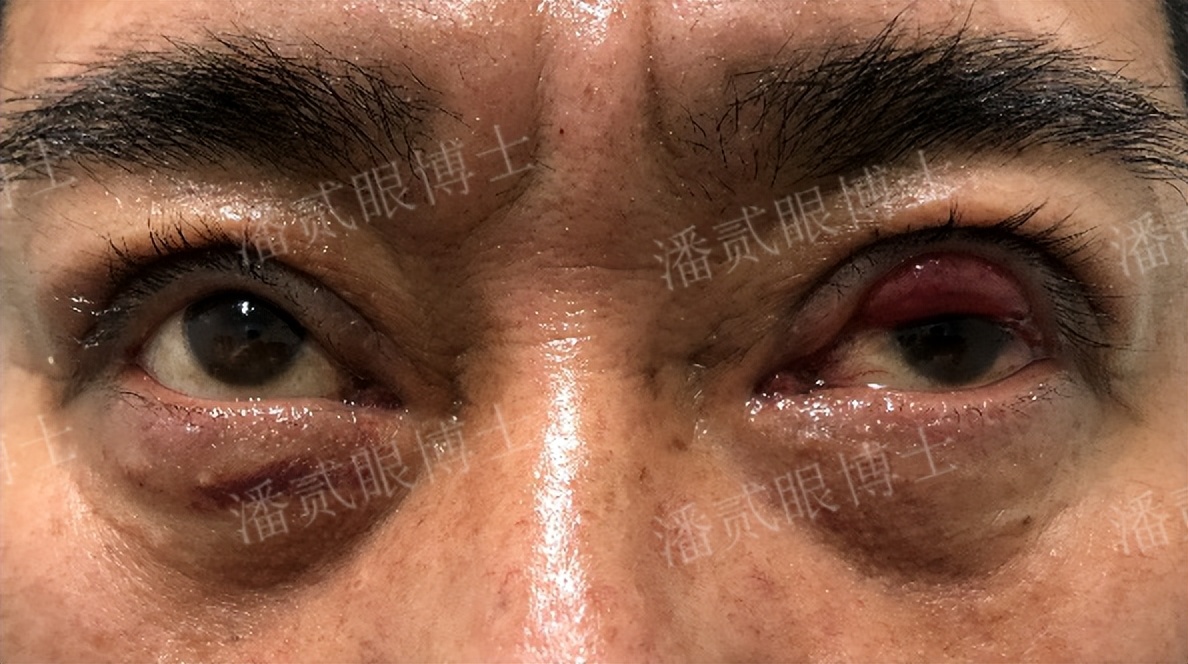 双眼皮修复潘贰博士地址,双眼皮失败二次修复视频