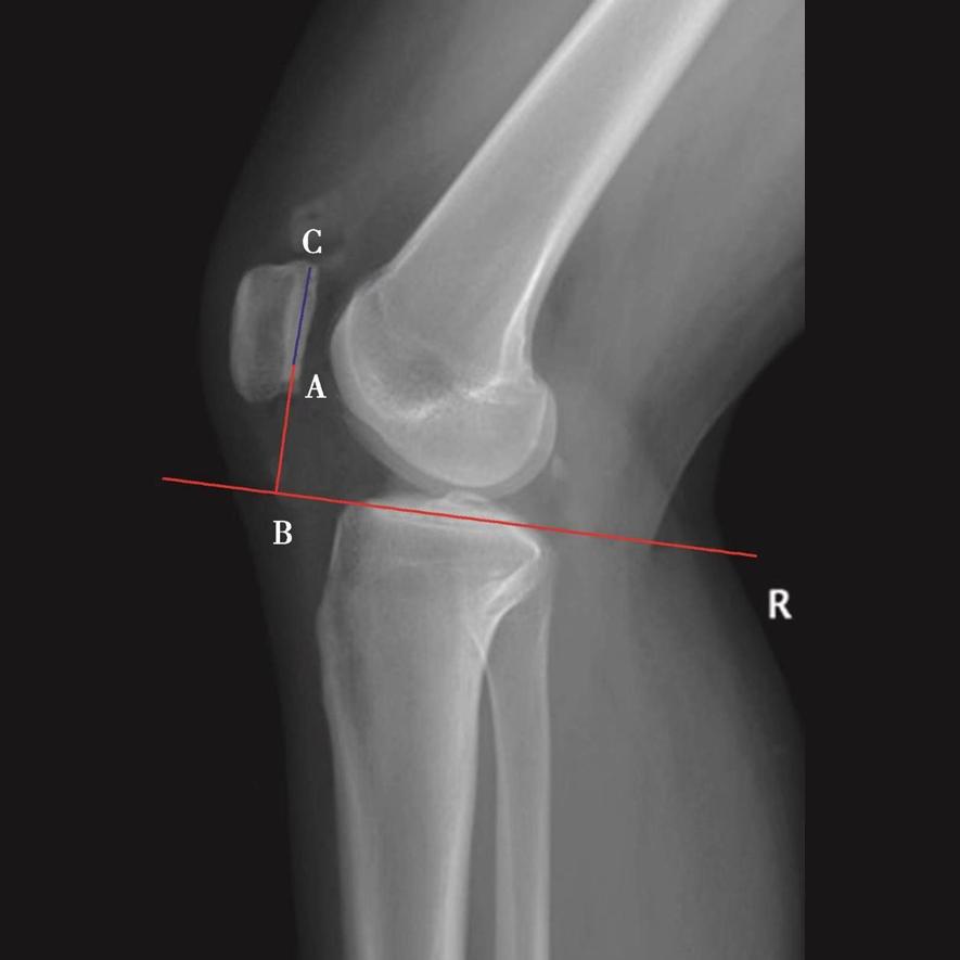 髌骨骨折评估,髌骨上下滑动评估什么内容