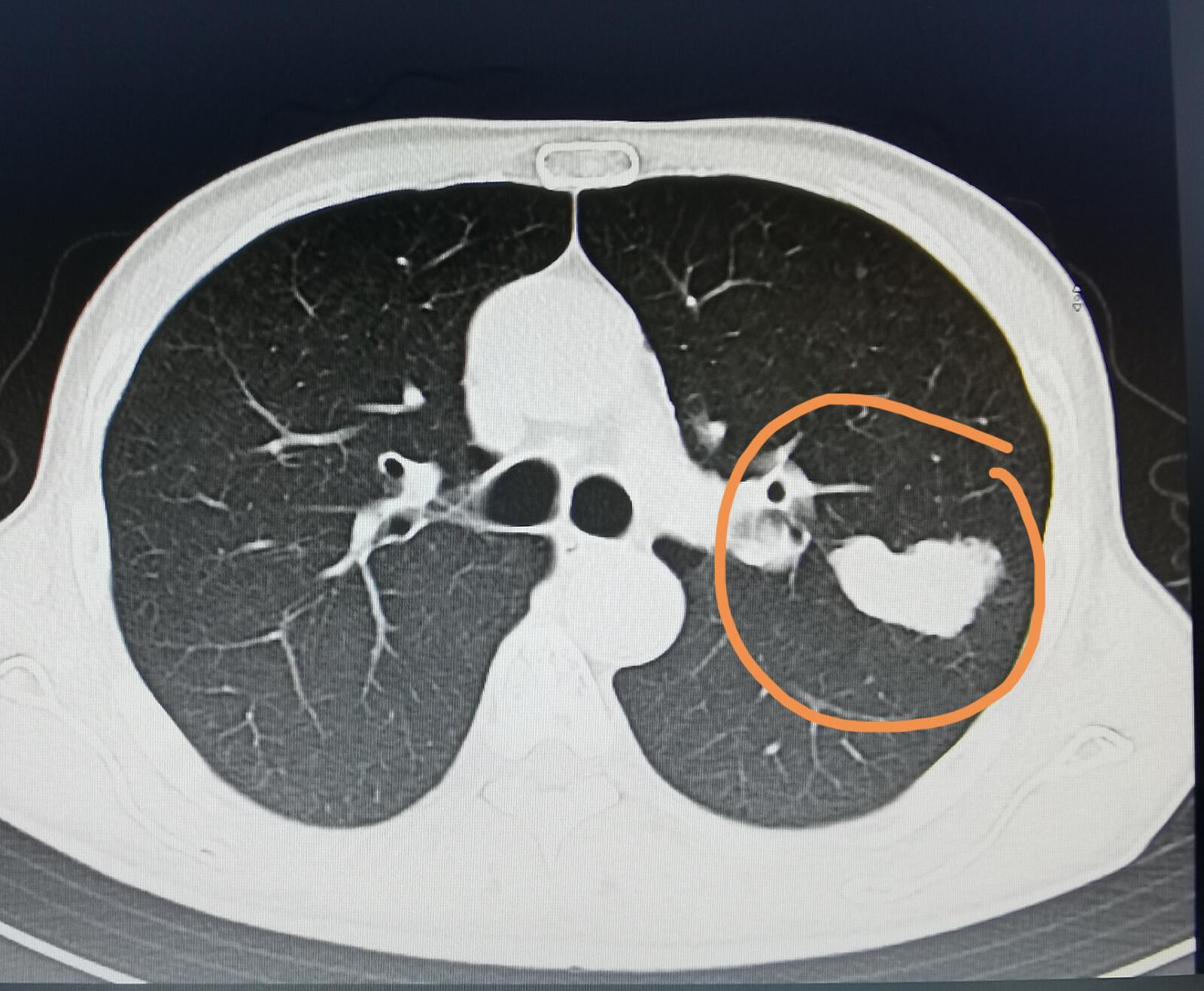 刘懿博士肺癌晚期,刘懿博士说肺癌全集