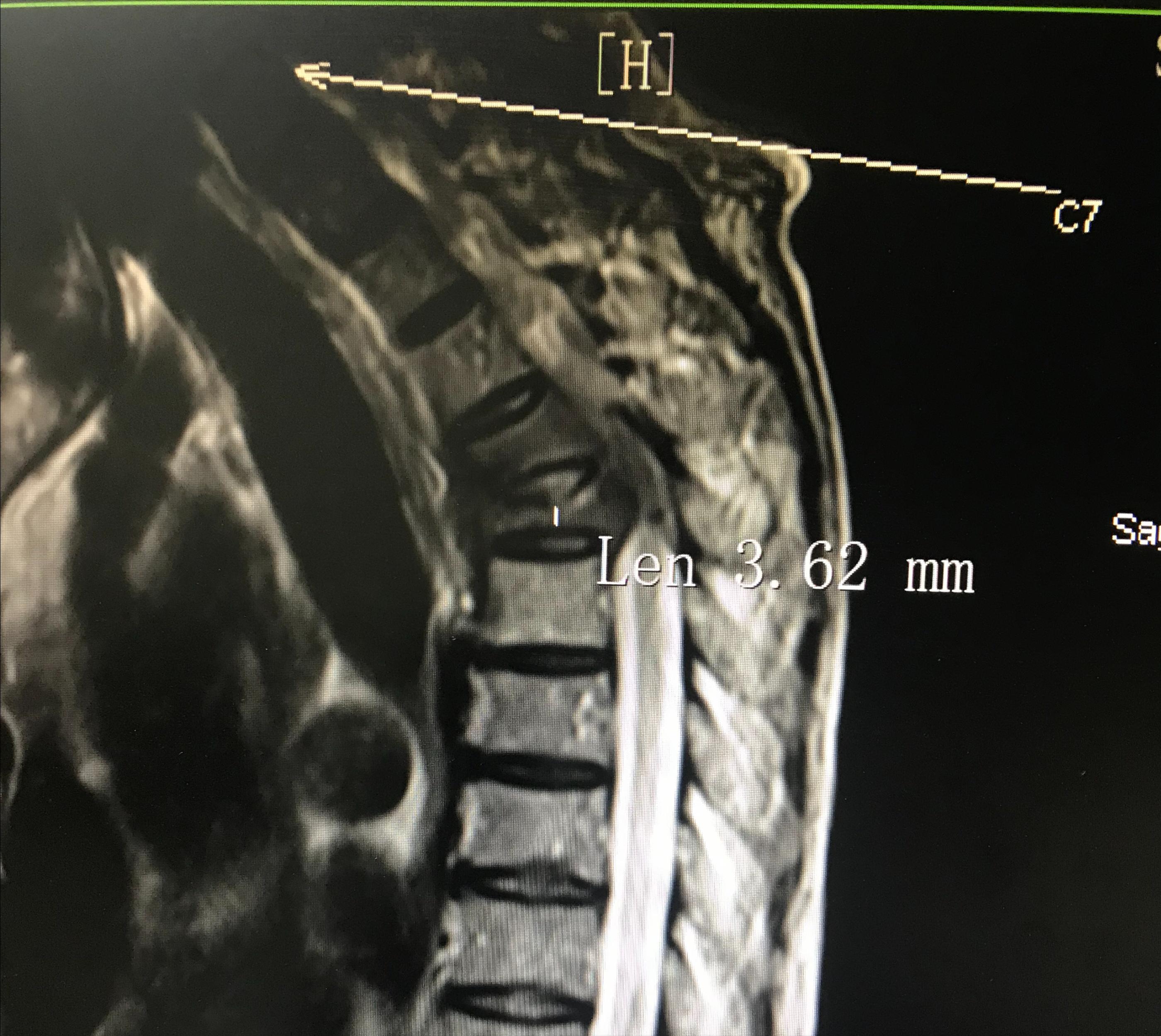 胸椎压缩性骨折微创手术利弊,胸椎压缩性骨折保守治疗20例