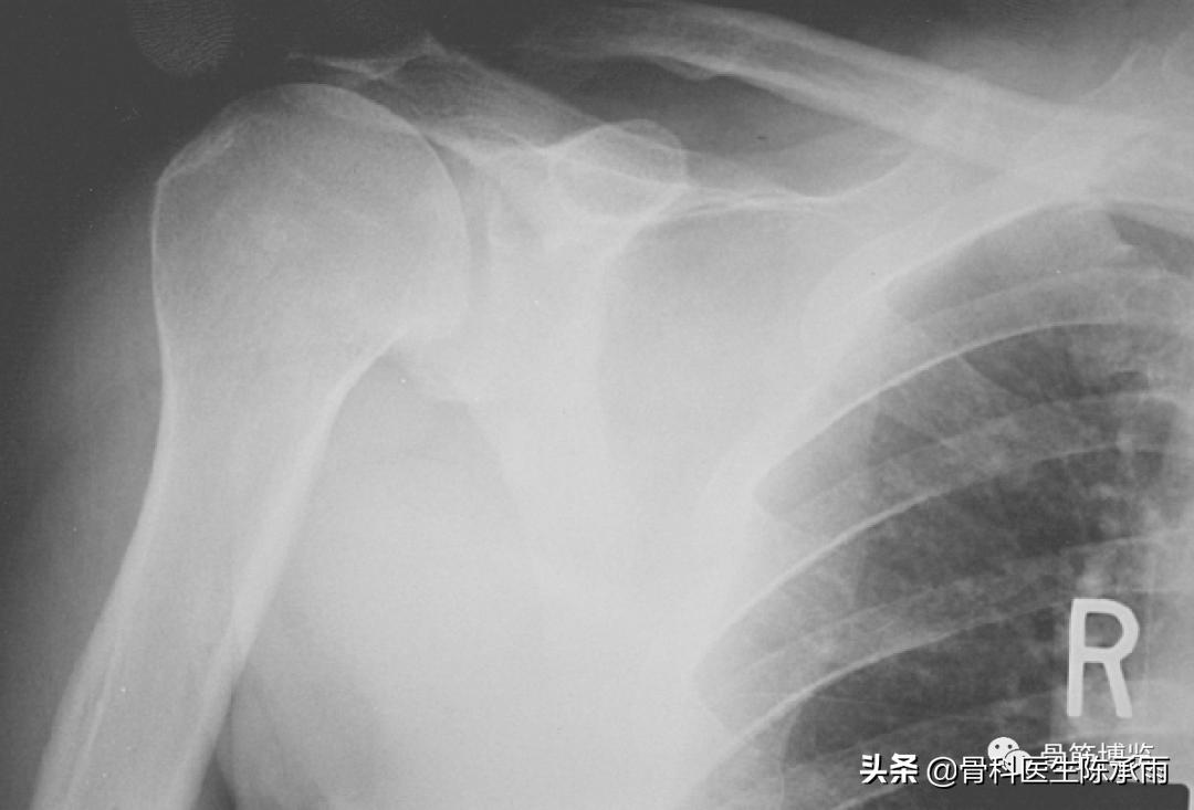 肩袖损伤诊断及关节镜下治疗