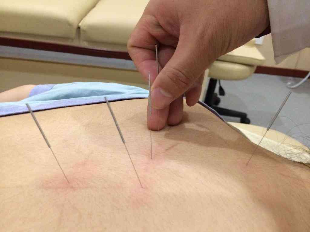 中医治疗多囊卵巢综合症效果好吗,舒氏针灸一般能治好多囊卵巢吗