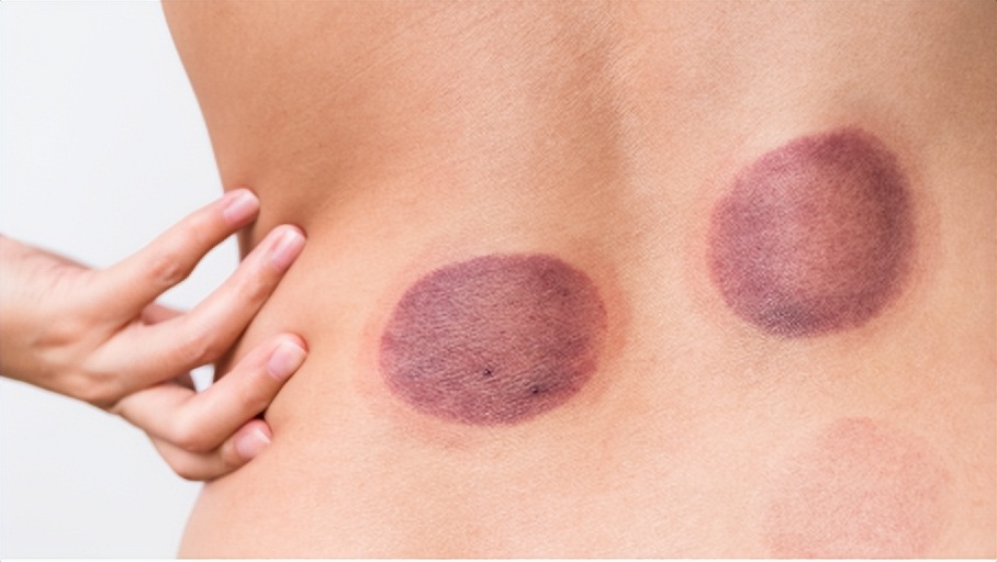 拔火罐益处和弊端,拔火罐有什么好处跟坏处呀