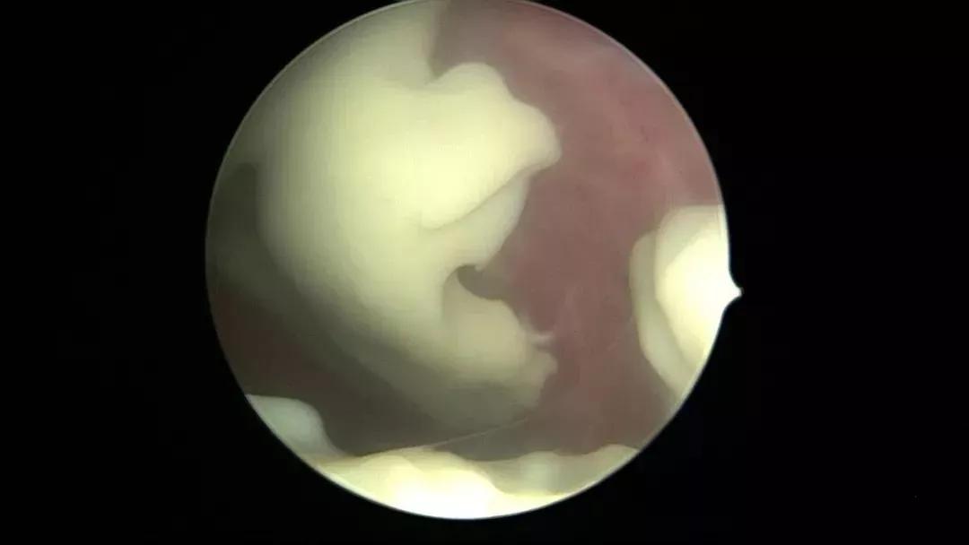 子宫里也会有脓？！这不是危言耸听，图文带你看懂