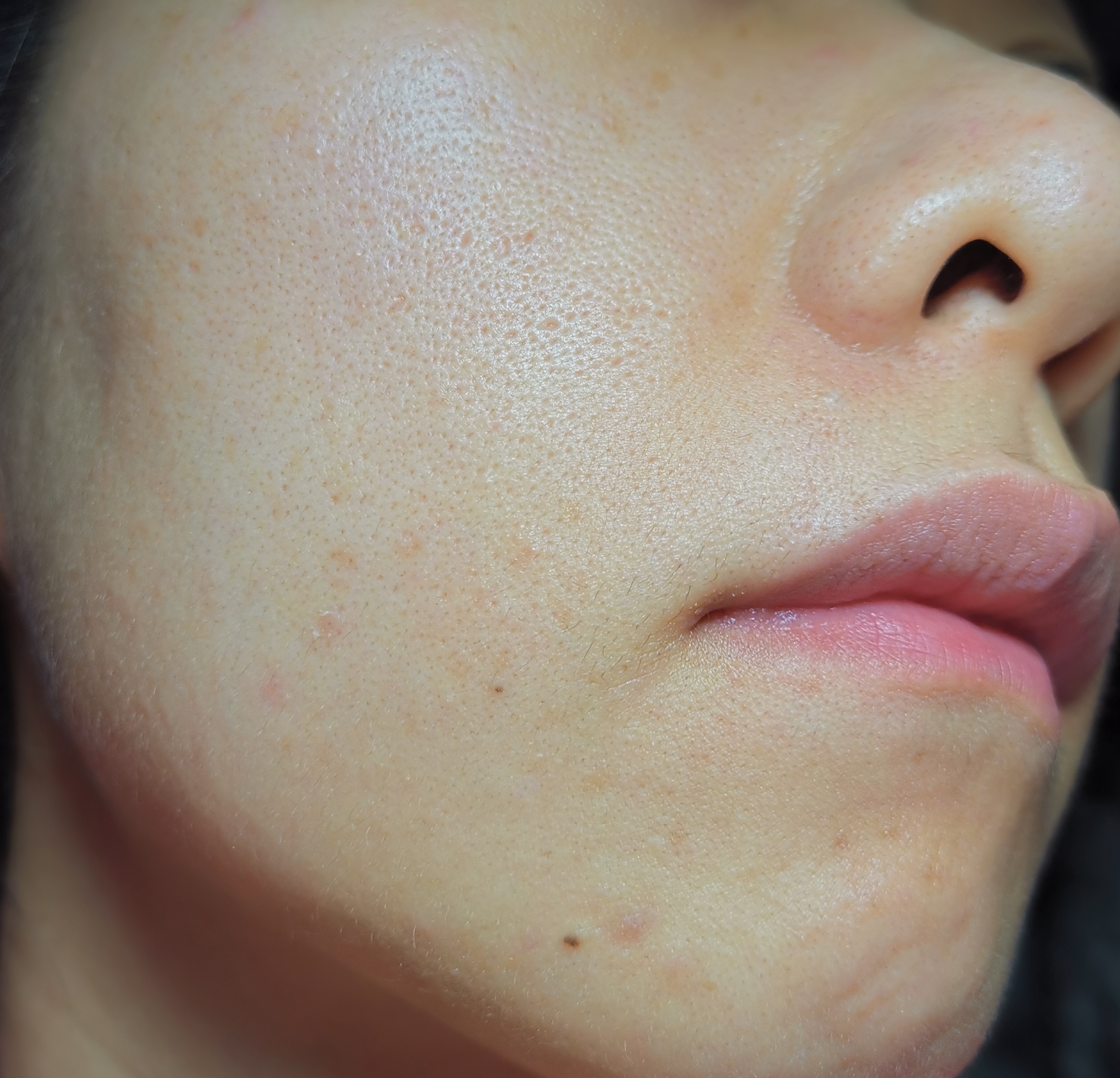 真人测评15天祛痘,真实测评一个月效果