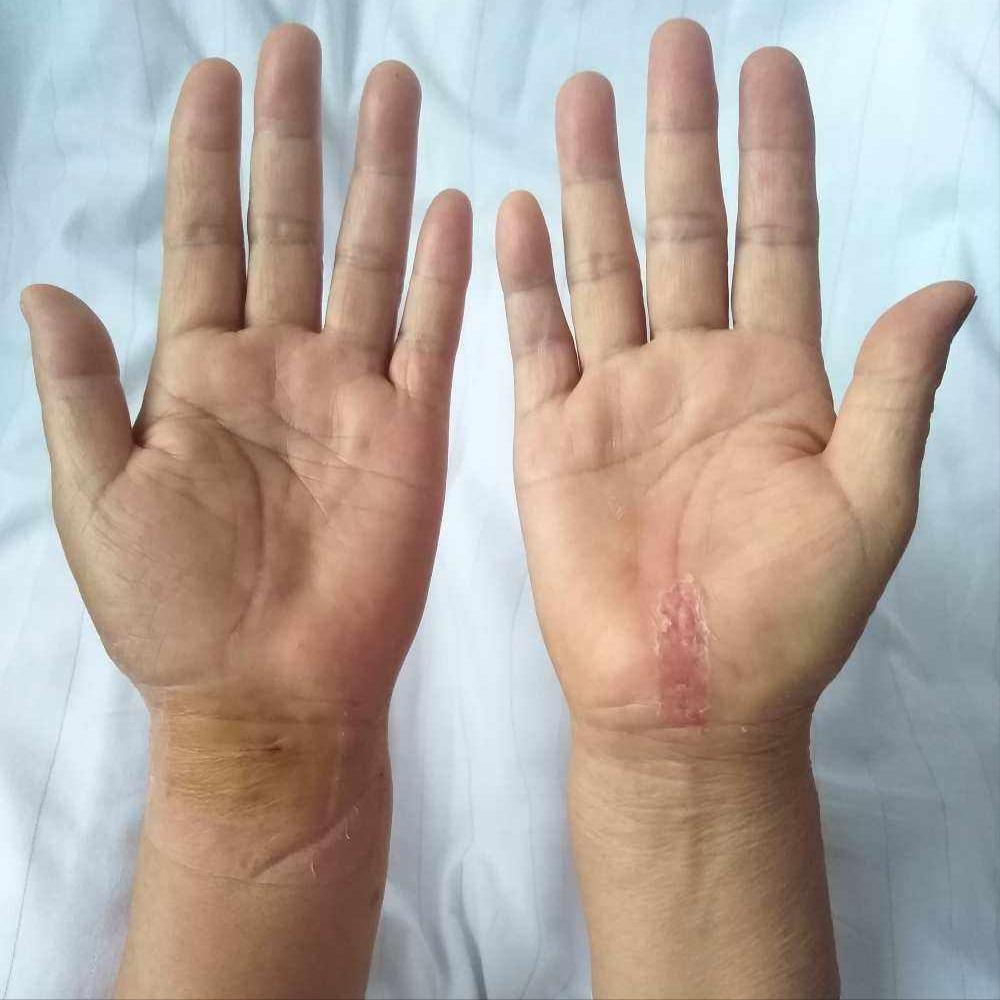 富血小板血浆因子作用,富血小板血浆治疗的目的和意义