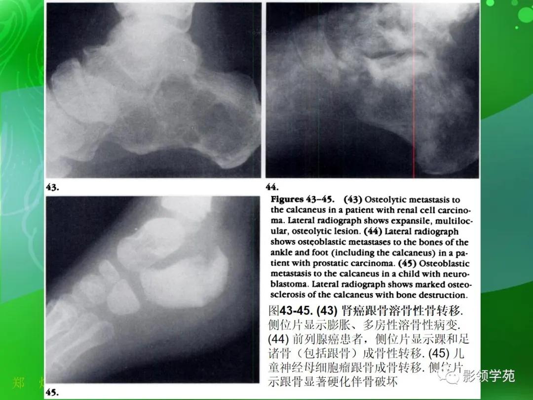 正常跟骨影像图,跟骨正常与变异影像表现图片
