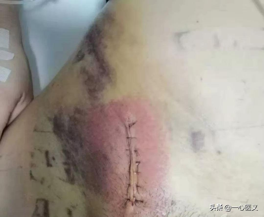 无张力疝气修补后一辈子不复发吗,腹股沟疝气无张力修补术会复发吗