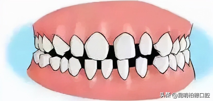牙齿掉了一半做烤瓷牙全过程,有关牙齿那些事儿