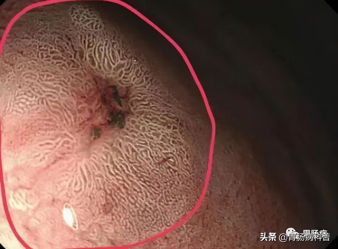 胃低分化含印戒细胞癌早期存活率,得印戒细胞癌的女孩