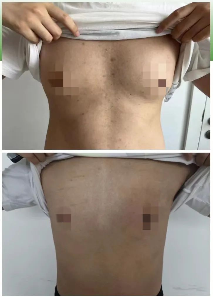 上海治疗男性乳房发育医院,高新区安泰医院