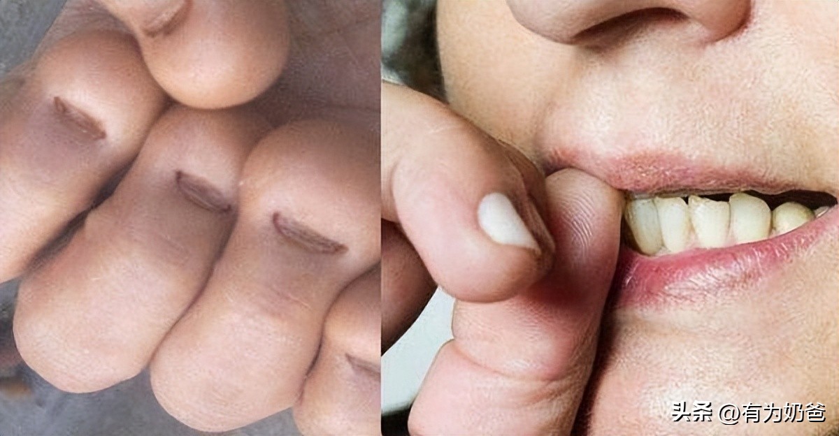 5岁儿童吃大拇指是什么原因,5岁了还吃大拇指正常吗