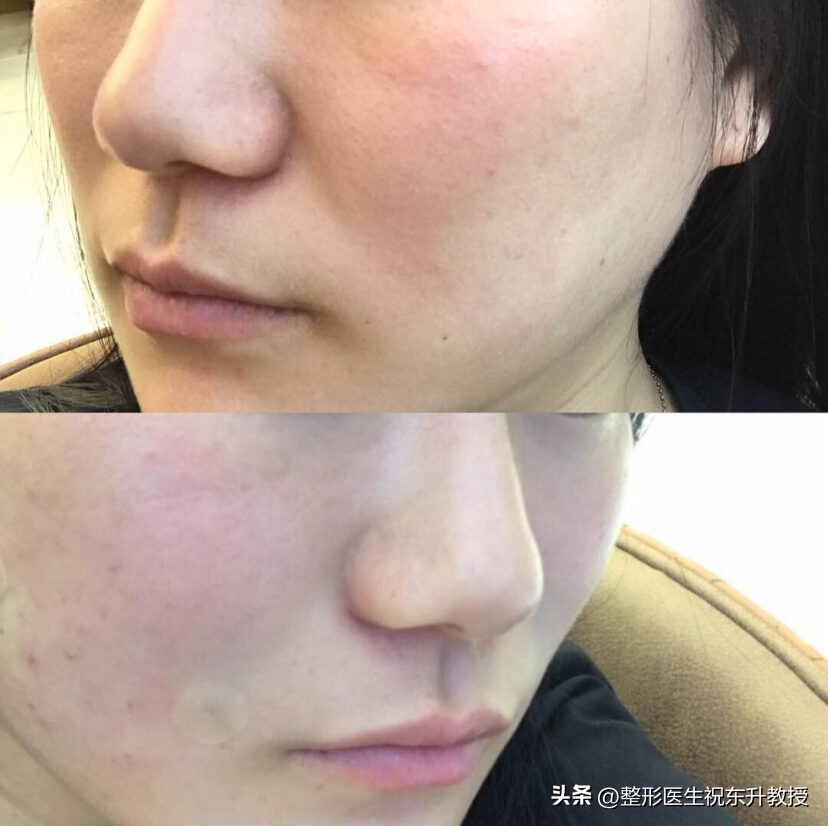 拉皮改善法令纹手术的危害有哪些,脸部法令纹做手术怎么去除