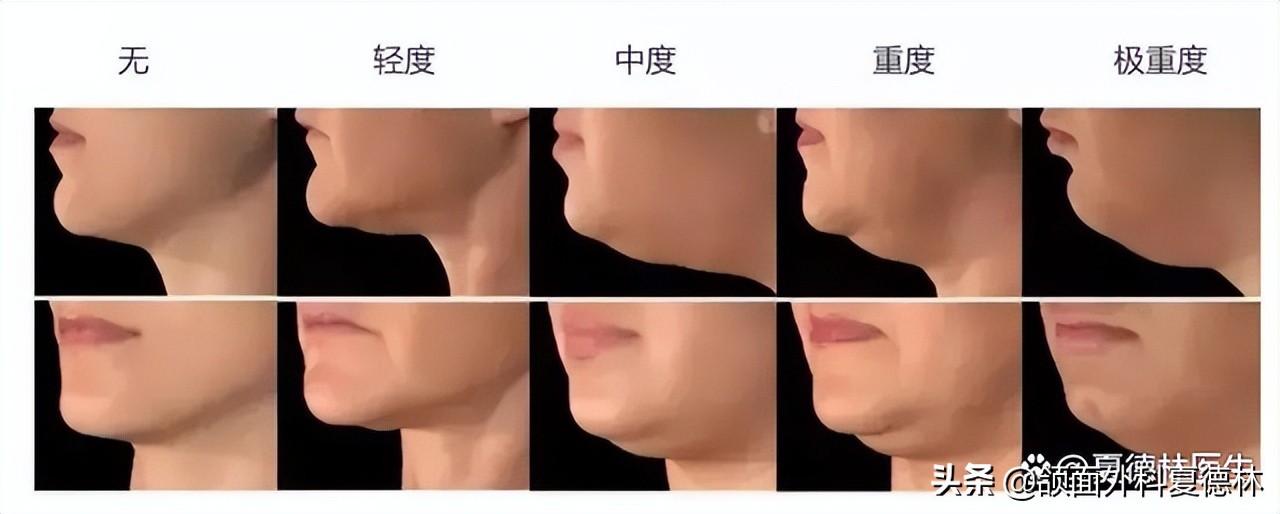 如何预防脸发腮,什么样的脸容易发腮