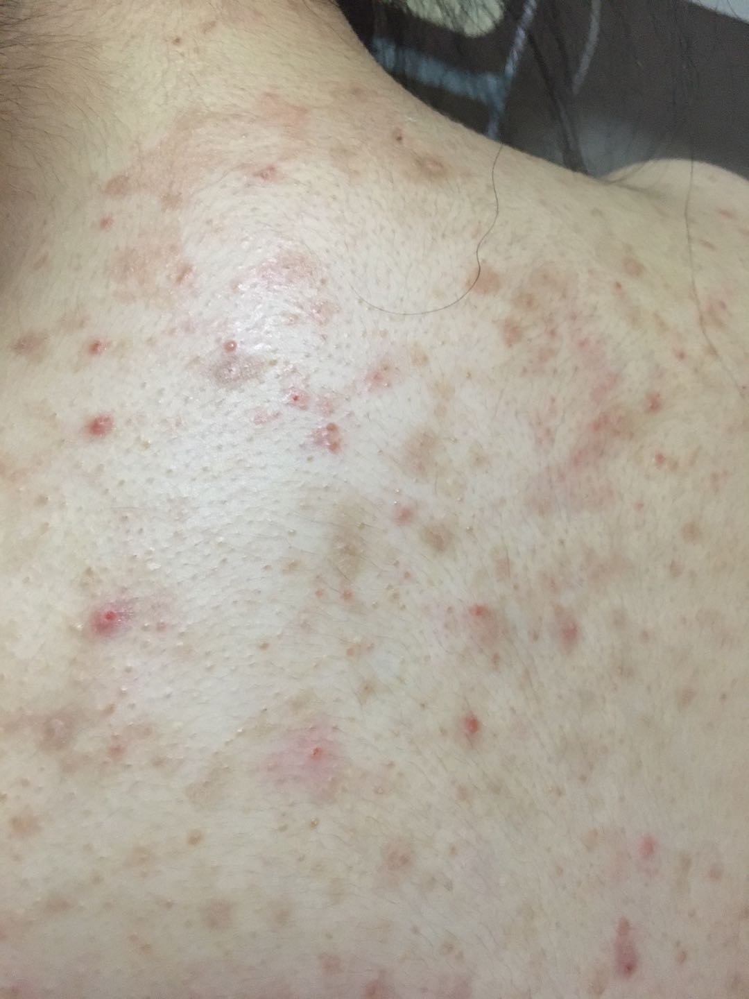 炎症后皮肤黑黑的,怎么办?