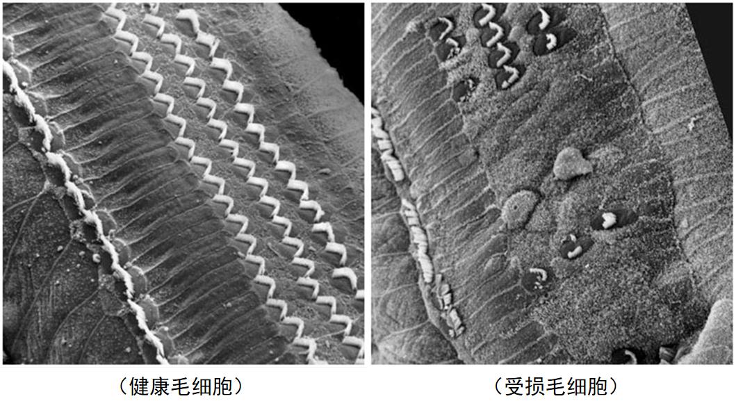噪声对听力损伤的表现,噪声引起听力损害如何干预