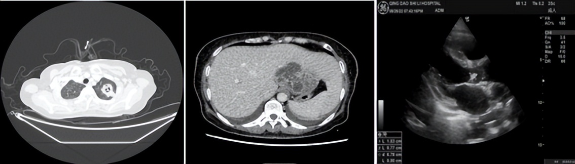 肺炎克雷伯菌侵袭眼内可治愈吗,高毒性肺炎克雷伯菌
