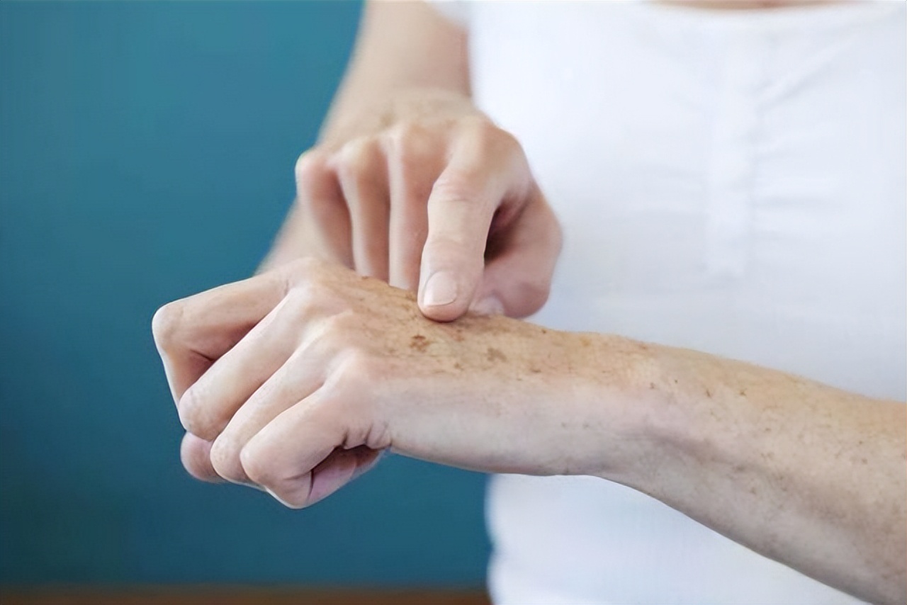 祛老年斑涂抹什么药膏有效,快速消除老年斑的小妙招红霉素