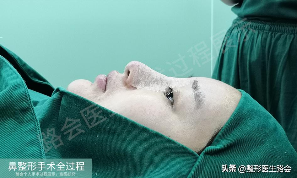 隆鼻手术全过程女生,隆鼻手术到底是怎么进行的