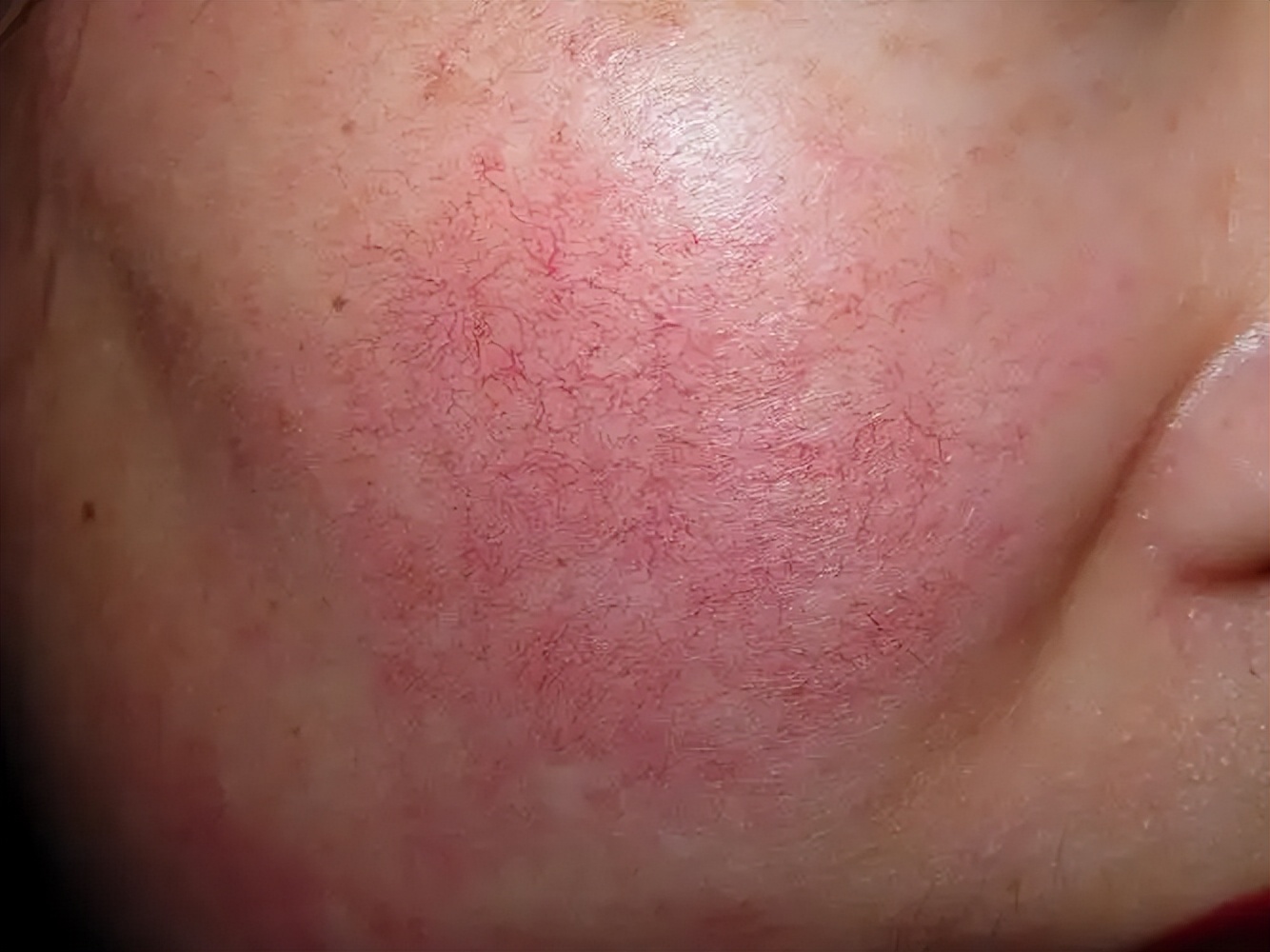 怎样去除脸部红血丝,脸部红血丝怎么去除最快最有效