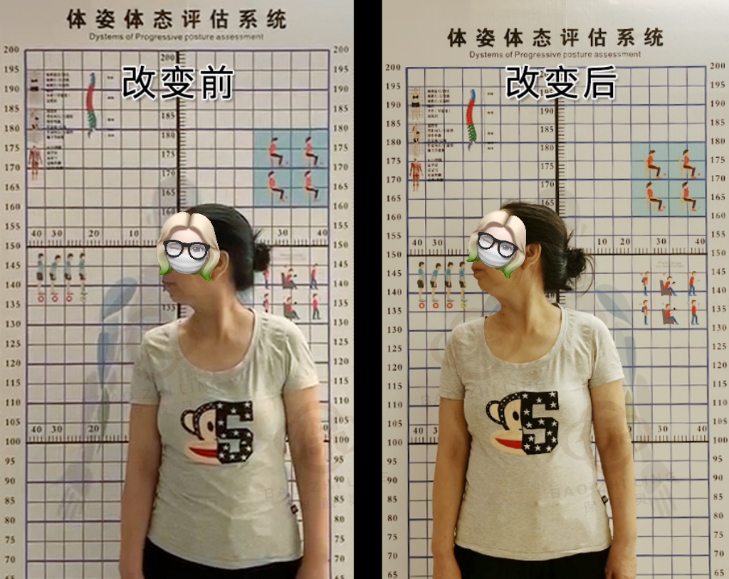 颈椎间盘突出压迫桡神经怎么恢复,颈椎间盘突出压迫手指麻怎么治疗