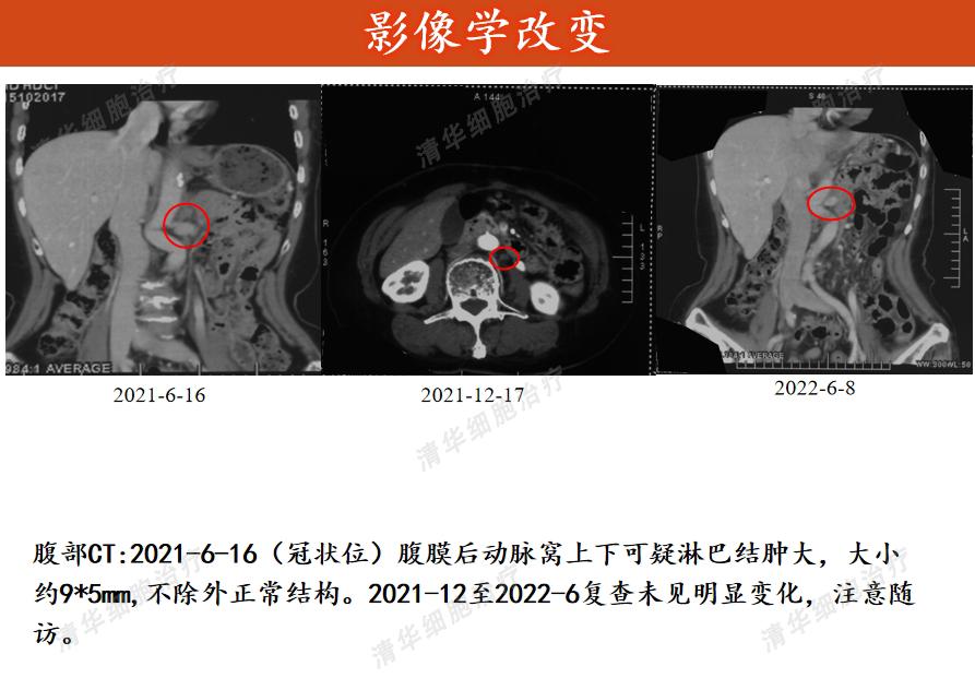 胰腺癌有突破10年的吗,一旦确诊胰腺癌还能活多久