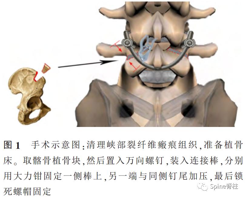 轻度峡部裂和重度峡部裂的区别,真性峡部裂和假性峡部裂