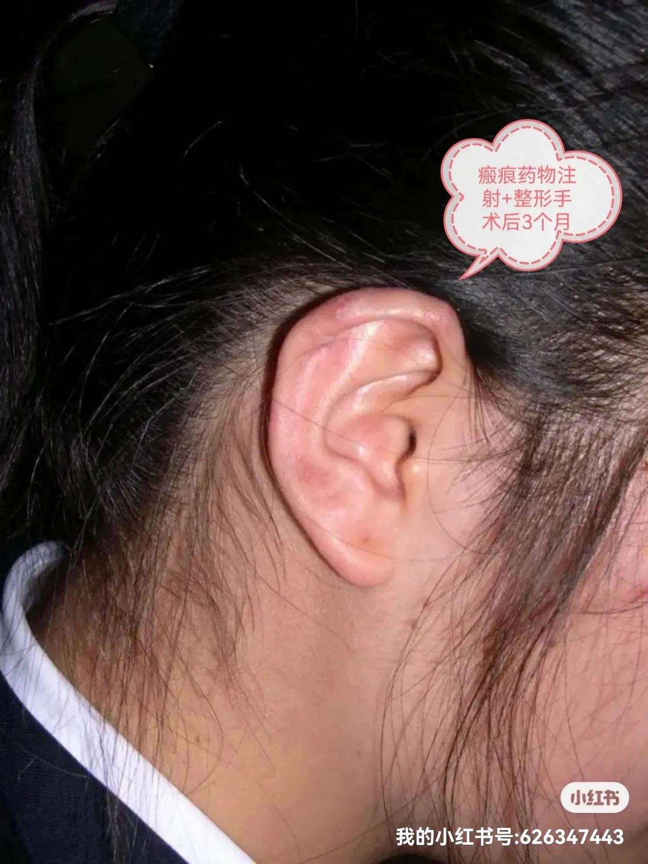 打耳洞引起的瘢痕疙瘩,打耳洞瘢痕疙瘩真实图片