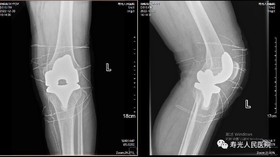 从云南到寿光，跨越四千里的信任丨一云南患者来寿光市人民医院关节创伤外科进行膝关节治疗