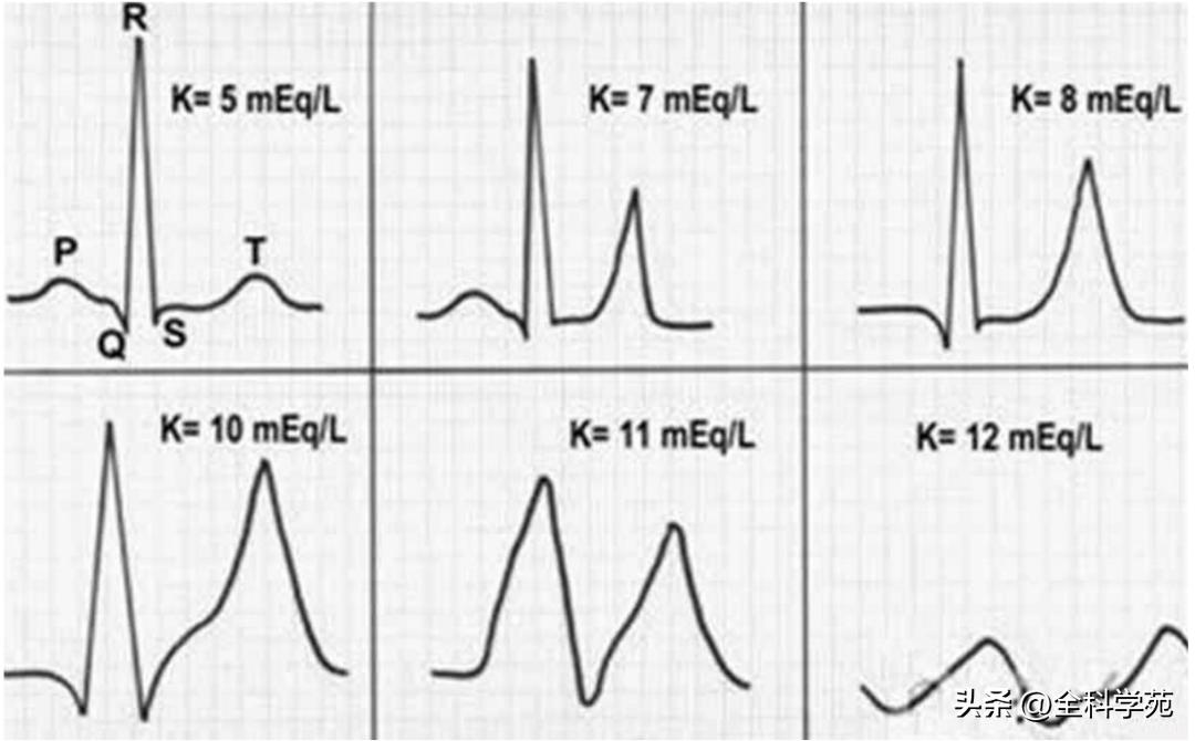 t波高尖心电图判断标准,t波高尖判断标准