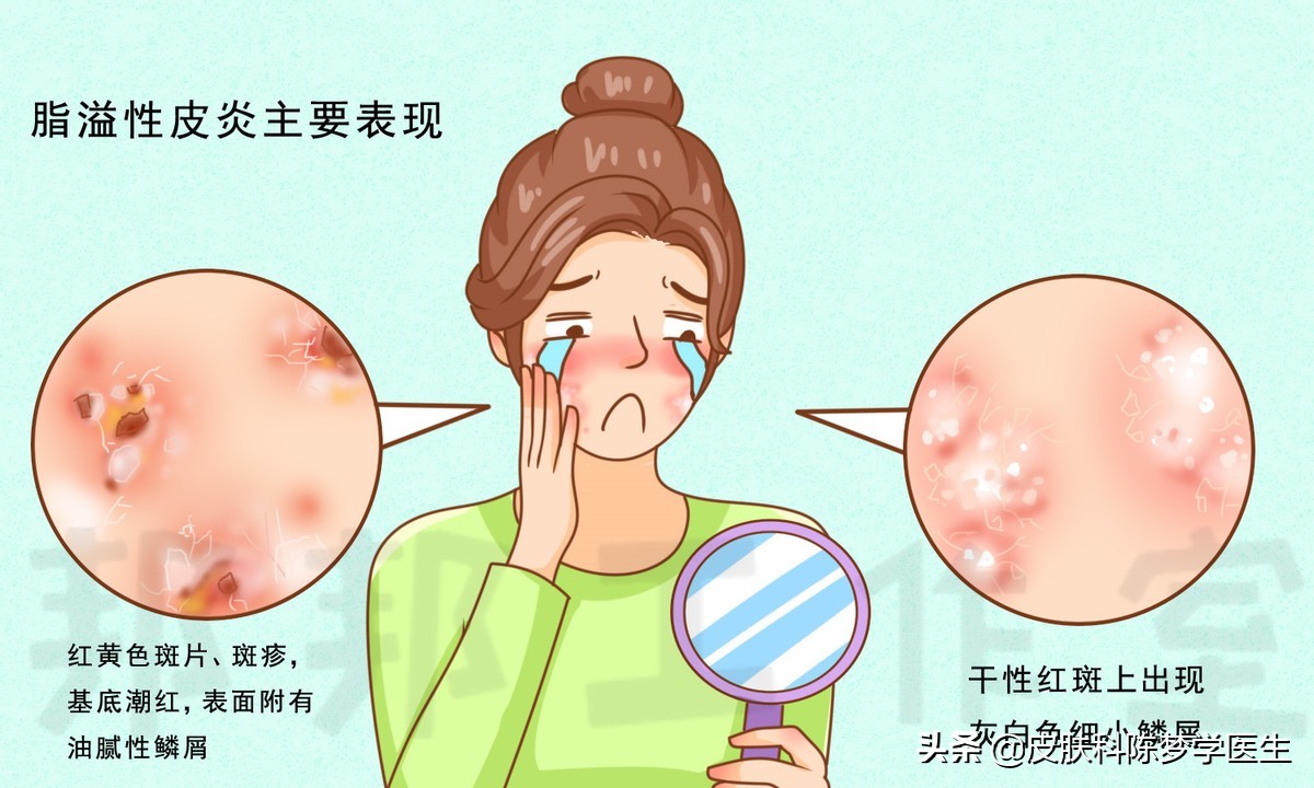 脸上银屑病引起的红斑突然严重,脂溢性皮炎脸上有一块块红斑