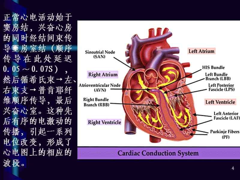 室性心动过速心电图解说,特发性室性心动过速严重吗
