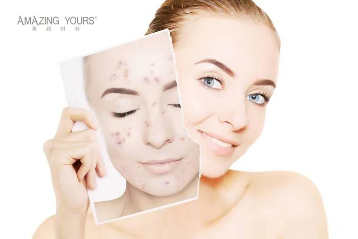 脸上长痘痘喝什么茶可以调理,满脸痘痘怎么治见效快医美