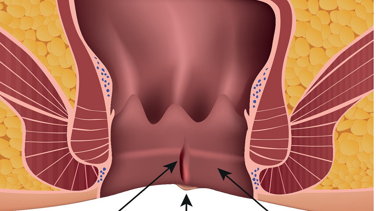 26岁女孩多次肛裂,女性哪些生活习惯会引发肛裂