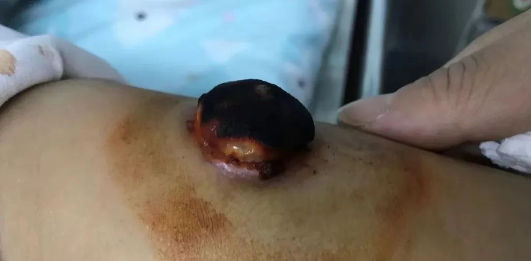 卡介苗最严重的异常反应,令人感染的肺炎疫苗