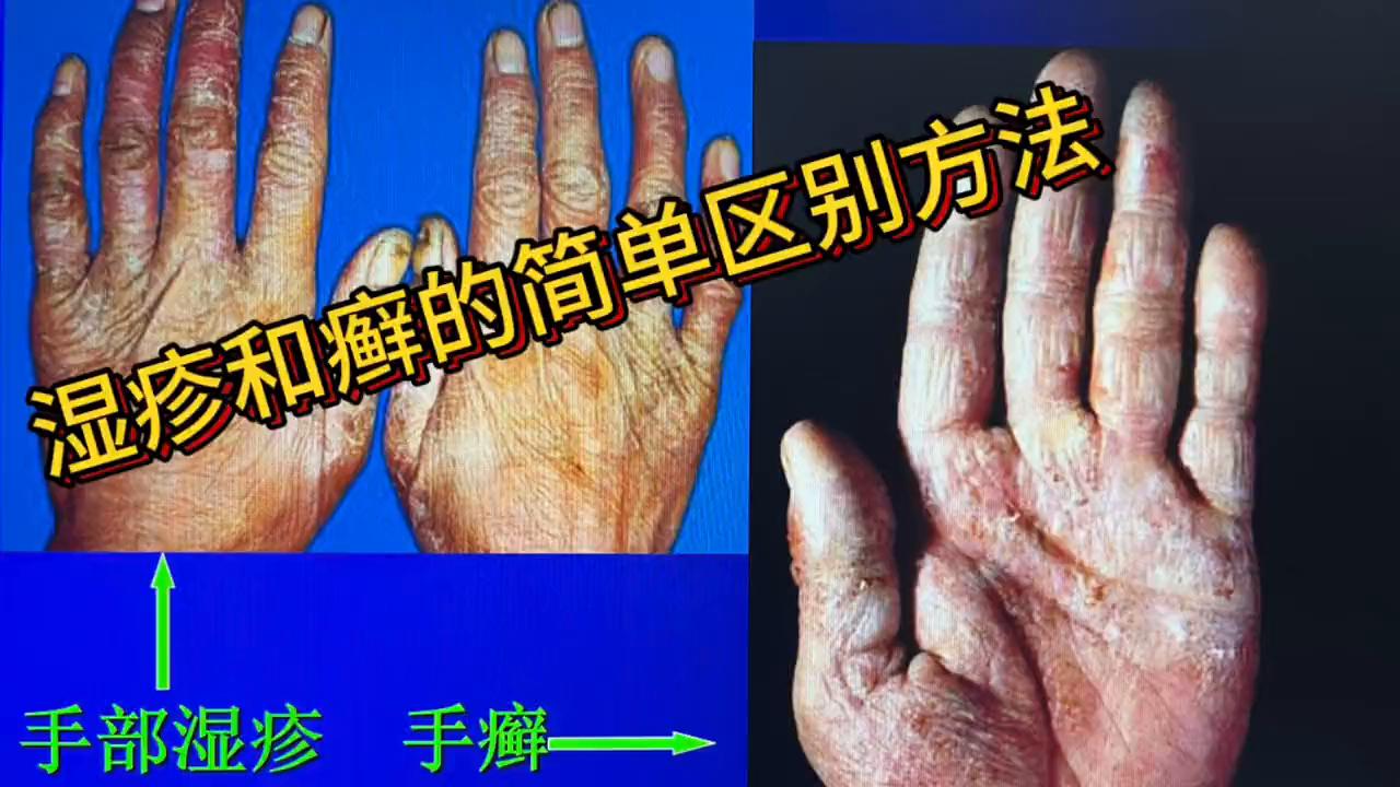 金钱癣和湿疹有什么区别,婴儿干性湿疹和癣的区别