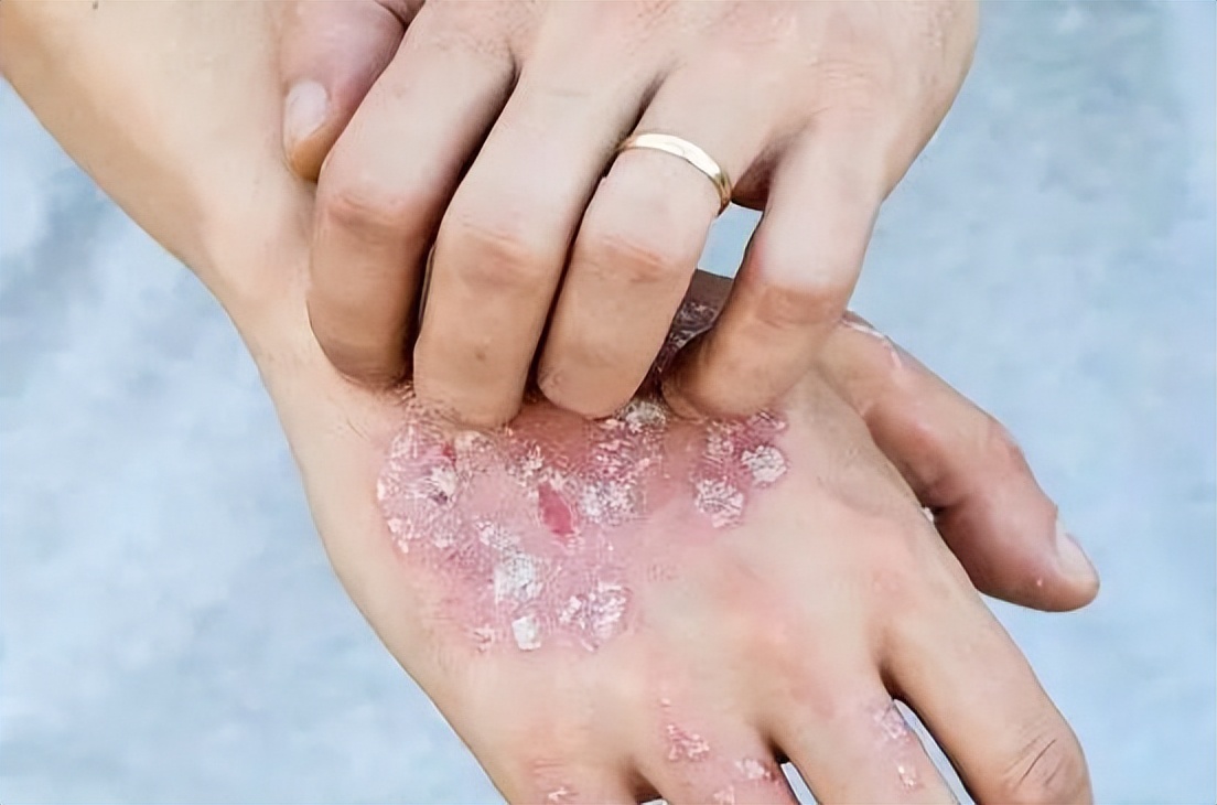 有哪些中成药治真菌肺炎,皮肤病真菌感染用什么药