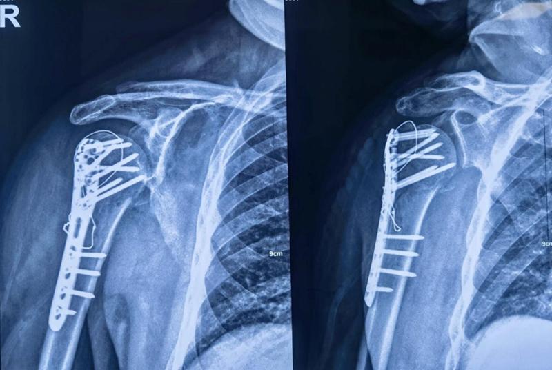 肱骨近端骨折属于几级伤残,肱骨近端骨折康复训练技巧