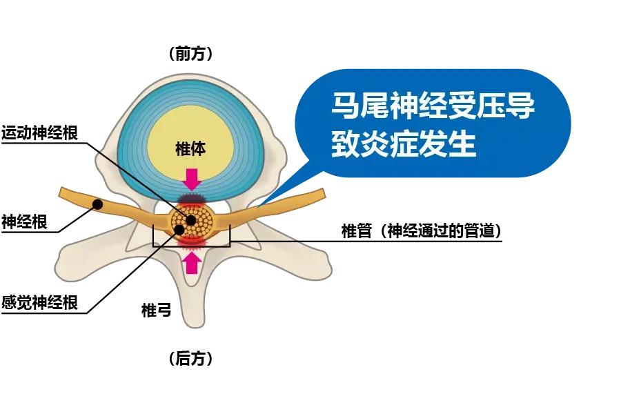 腰椎管狭窄腰腿痛间歇性跛行,腰椎管狭窄压迫神经腿麻木怎么治