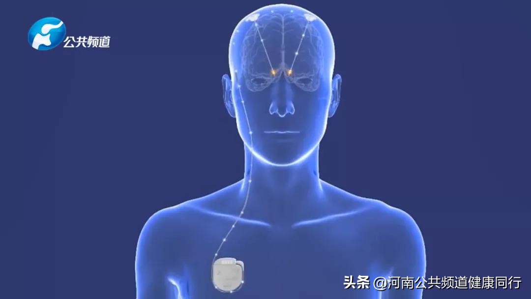 射频消融手术治疗梅杰综合征,梅杰综合征微创手术治疗