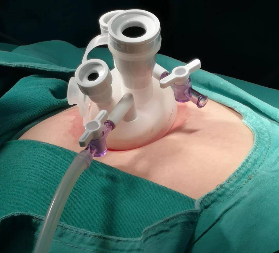 单孔腹腔镜不适合哪些妇科手术,妇科单孔腹腔镜