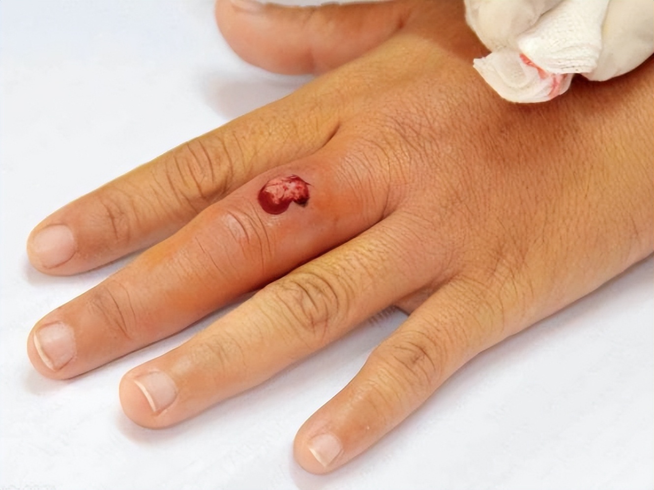 几元钱的甲硝唑能摆平五种病,几元一瓶的甲硝唑或能缓解3种病