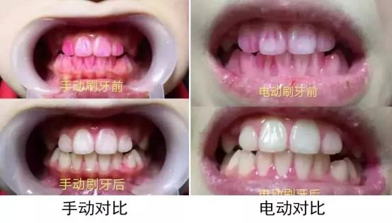 电动牙刷和冲牙器哪个是智商税,声波牙刷是智商税吗