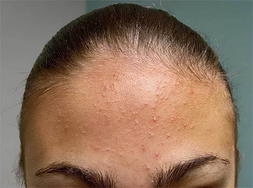 痘痘肌的十大内调方法,痘痘肌要怎么内调