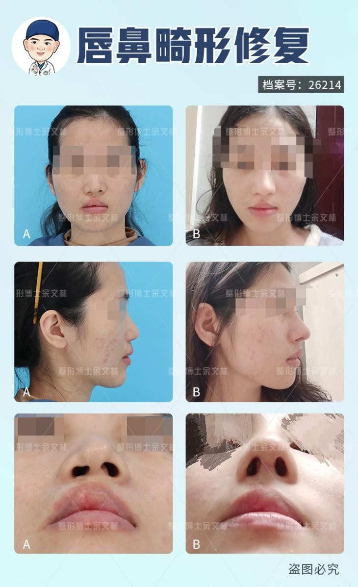 唇裂先牙齿矫正还是鼻畸形先矫正,唇裂畸形的手术修复