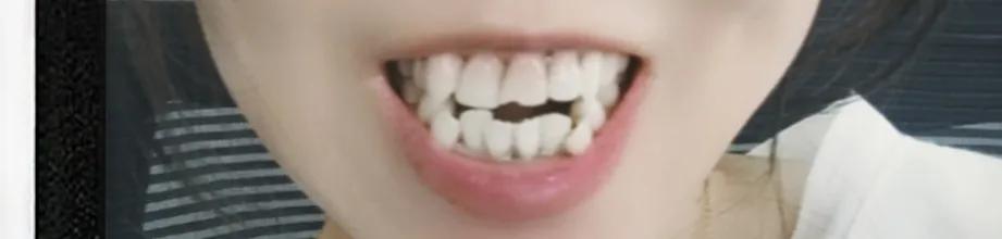 牙疼一般疼几天会自愈,牙疼脸肿了怎么快速消肿