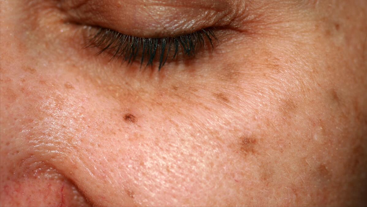 快速消除老年斑的小妙招红霉素,红霉素软膏对老年斑有治疗作用吗