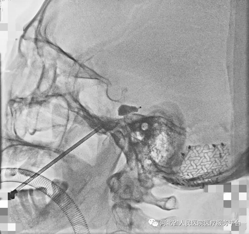 三叉神经痛疼得受不了该怎么办,人为因素造成三叉神经痛
